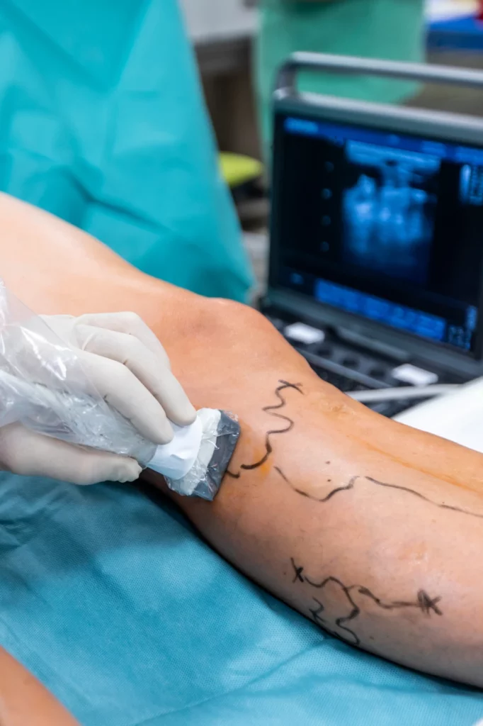 Cirurgia e Microcirurgia de Varizes